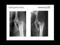 Hip Dysplasia in Dogs