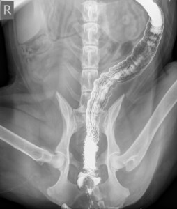 Radiograph taken after barium has been administered into the large intestine to highlight the gut.