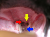 This picture shows the throat of a brachycephalic dog. The soft palate is too long (yellow arrow), impinging on the entry to the larynx (red arrow) which is just above the endotracheal tube (blue arrow)