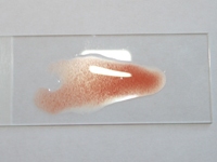 Autoagglutination of red cells in a blood smear – typical of IMHA cases