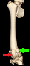 Figure 1. This shows  a 3 dimensional model created using a CT scanner showing the femur and stifle joint of a bow legged Rottweiler with patellar luxation