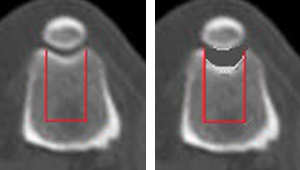 Figure 5. CT scan showing a new deeper groove to prevent patellar luxation and a slipping knee cap