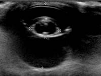 Figure 4: This is an ultrasound image of an eye with cataracts. The lentil shaped structure in the middle of the eye is the lens.