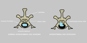 Intervertebral disc anatomy, illustrating what is normal (left) and an extruded disc (right)