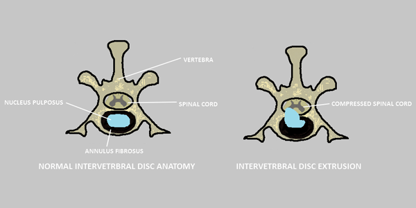 Intervertebral disc anatomy, showing vertebrae in cross section, illustrating what is normal (left) and an extruded disc (right)