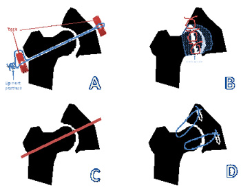 Fig 3: Representation of several repair techniques used for hip dislocation surgery