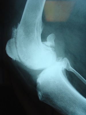 This dog has severe osteoarthritis caused by a chronic rupture of the cruciate ligament. This joint has been irreversibly damaged and persistence of lameness is likely to persist.