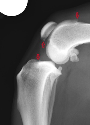 Most dogs with rupture of the cruciate ligament will have some degree of new bone formation in the areas highlighted by the arrows. This bone formation is associated with osteoarthritis and is expected to become progressively worse with time.