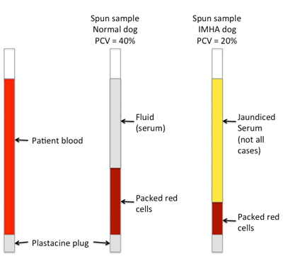 An illustration to show how PCV is measured in capillary tubes