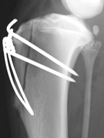 Figure 3. Xray showing transposition of the tibial tuberosity to prevent patellar luxation in a large dog