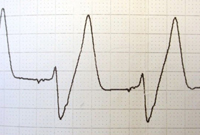Abnormal ECG trace in a blocked cat with hyperkalaemia