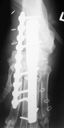 Fig 3: This x-ray shows a dog’s carpus after arthrodesis surgery. You can see the plates and pins which hold the wrist in place