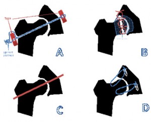 Fig 3: Representation of several repair techniques used for hip dislocation surgery
